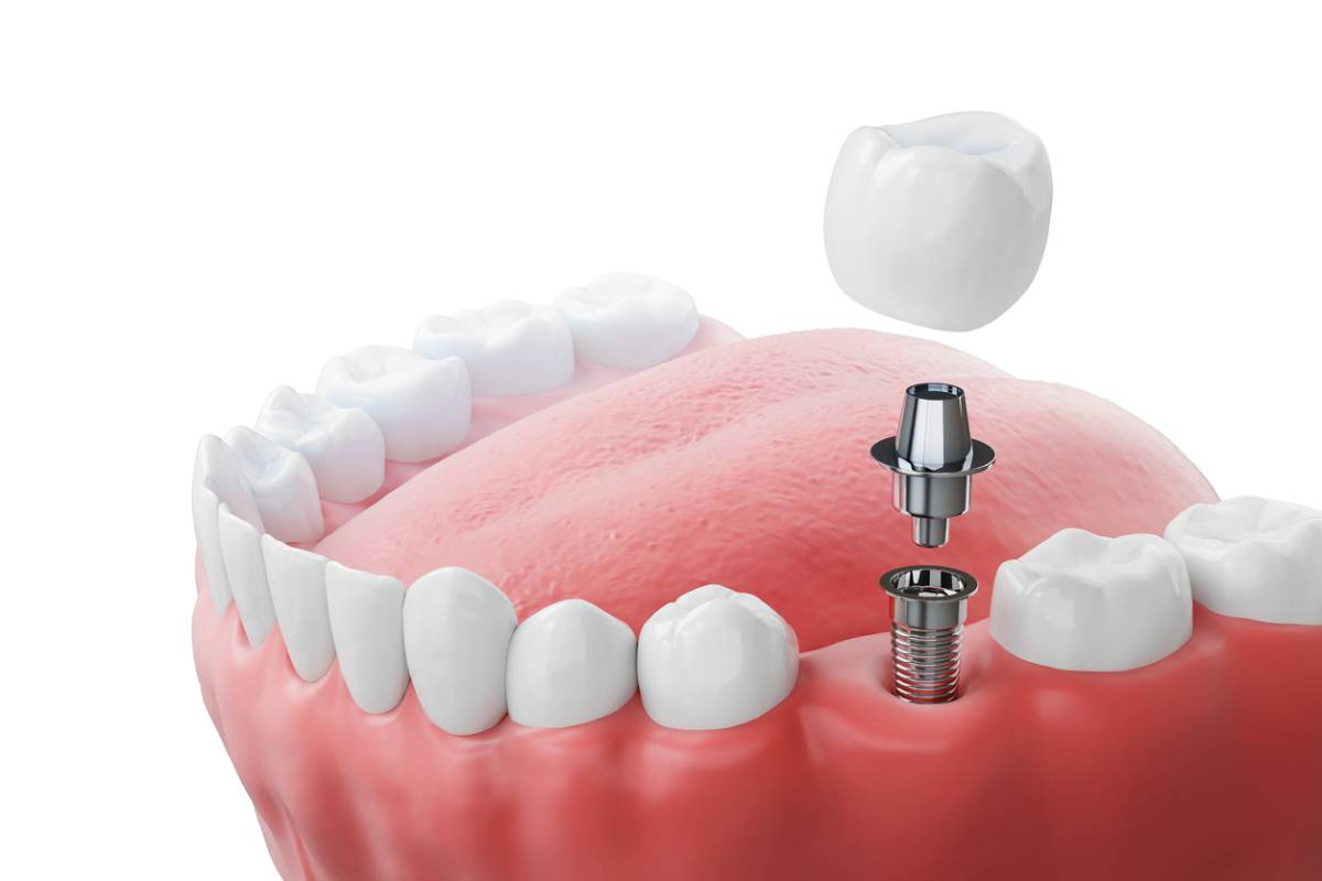 Dental implant procedure